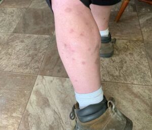 bed bug bites on a man's leg