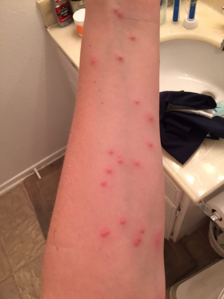 Bed bug bites showing up in a zigzag pattern on a person's arm