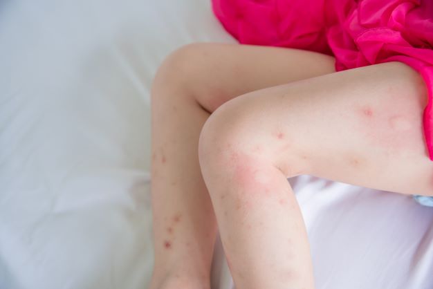 A girl's legs with bed bug bite marks