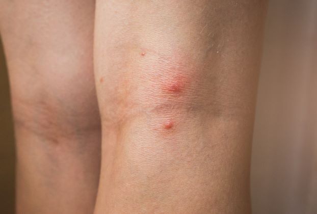 A bed bug bite on the back of a persons leg
