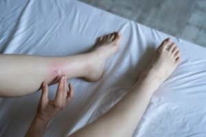 Woman treating bug bite on her leg while on bed