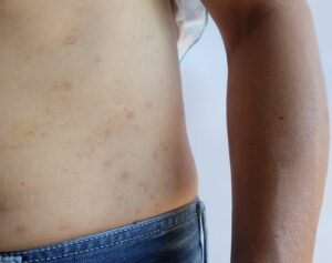 Bed bug bites on man's torso and side