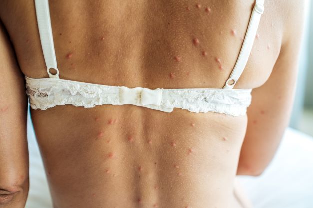 Bed bug bites on the back of a woman